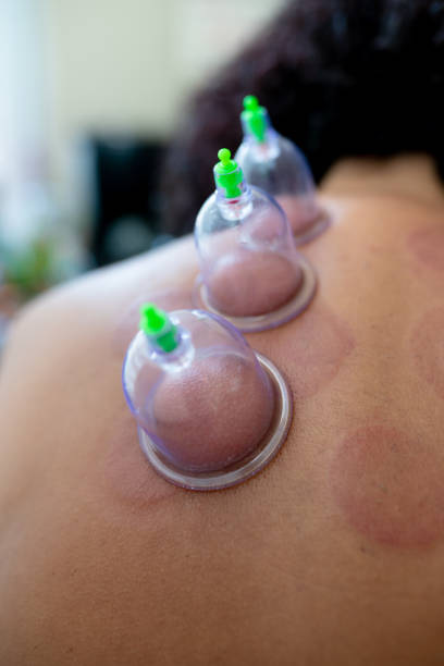 istock hijama cupping thrapy on women 1158278059