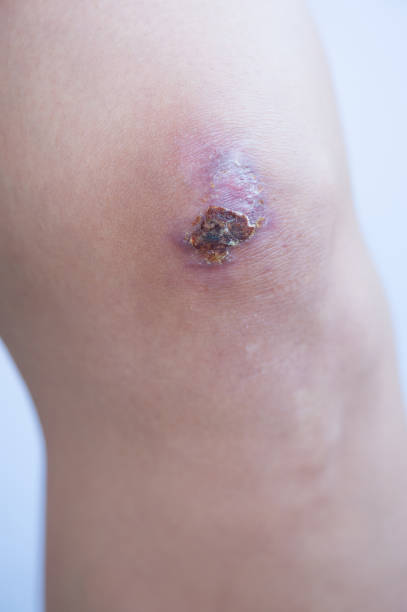 Scar and scab (eschar) on asian female knee Scar and scab (eschar) on asian female knee eschar stock pictures, royalty-free photos & images