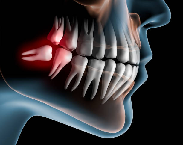 Lying Wisdom Tooth in the Lower Jaw - 3D Rendering Reclining wisdom tooth in the lower jaw in front of dark background - 3D Illustration animal jaw bone stock pictures, royalty-free photos & images