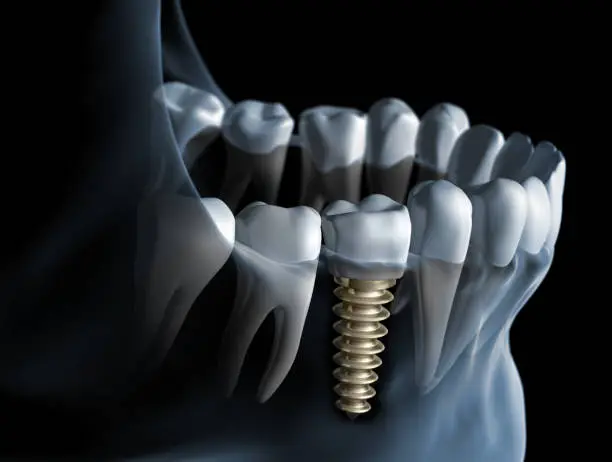 Close-up of a dental implant with crown in the lower jaw against a dark background - 3D illustration