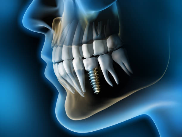 Medical Visualization - Dental Implant in the Jaw - 3D Rendering Close-up of a dental implant with crown in the lower jaw against a dark background - 3D illustration animal jaw bone stock pictures, royalty-free photos & images