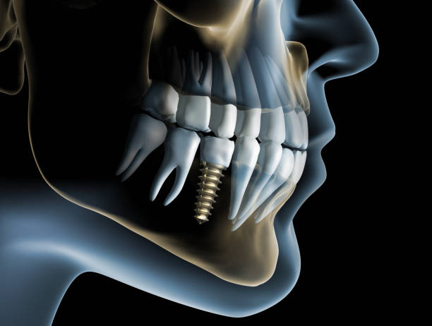 Medical Visualization - Dental Implant in the Jaw - 3D Rendering Close-up of a dental implant with crown in the lower jaw against a dark background - 3D illustration animal jaw bone stock pictures, royalty-free photos & images