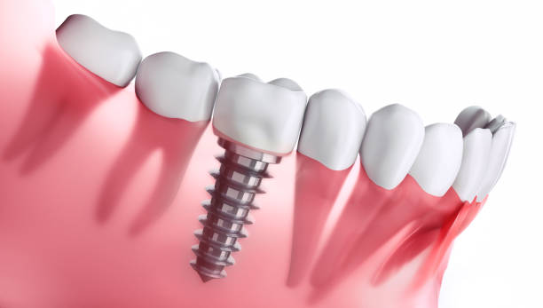 implant dentaire de plan rapproché dans la mâchoire - implant photos et images de collection
