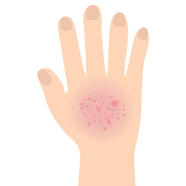 illustrazioni stock, clip art, cartoni animati e icone di tendenza di eczema ha colpito una mano concetto di malattia della pelle dermatologica - 4694