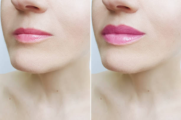 woman lips before and after augmentation woman lips before and after augmentation retouching stock pictures, royalty-free photos & images