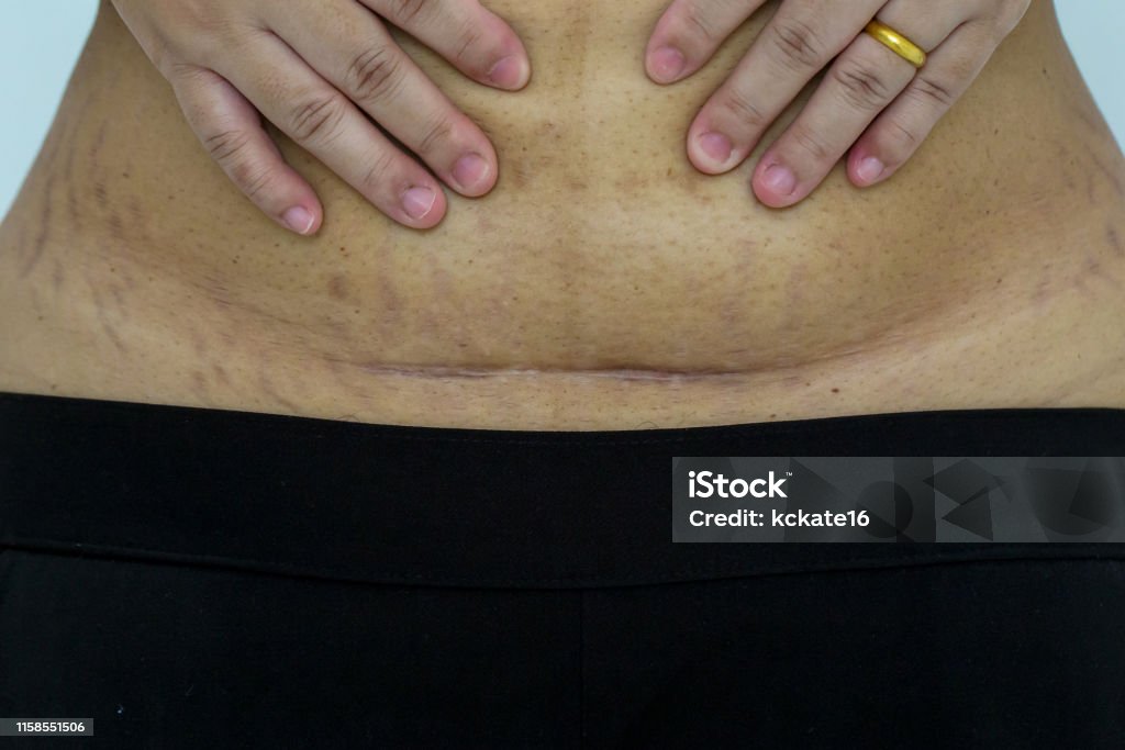 Slim and fit figure after the longitudinal caesarean section. Scar after a Caesarean section, Bikini line. Slim and fit figure after the longitudinal caesarean section. Scar after a Caesarean section, Bikini line. Closeup of a scar on the belly of a woman who had a caesarean operation. Caesarean Section Stock Photo