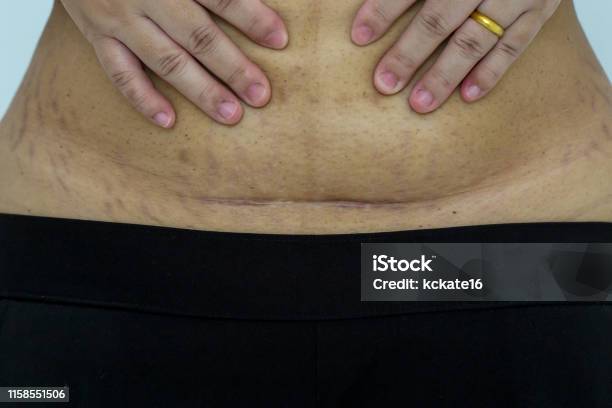 Slim And Fit Figure After The Longitudinal Caesarean Section Scar After A Caesarean Section Bikini Line Stock Photo - Download Image Now