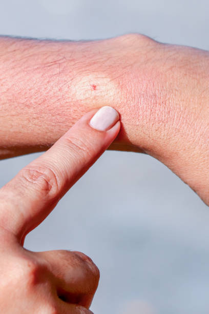 istock Bee sting on human skin 1158618479