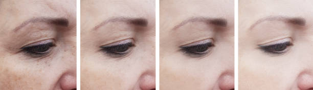 istock woman face wrinkles before and after correction 1158668608