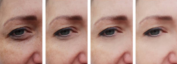 istock woman face wrinkles before and after correction 1158671444