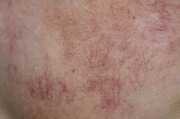 Close up skin with vascular stars and couperose. Close up skin with vascular stars and couperose dilation stock pictures, royalty-free photos & images