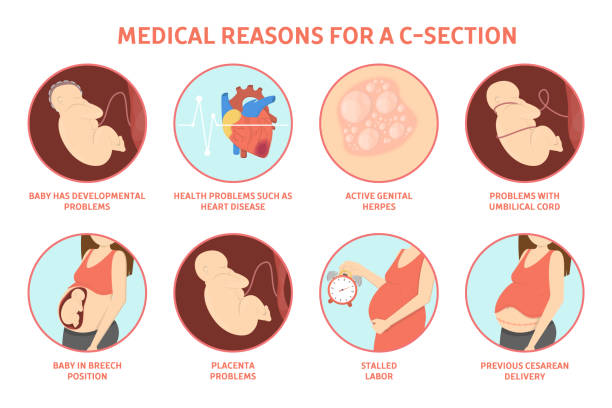 ilustraciones, imágenes clip art, dibujos animados e iconos de stock de razones médicas para el parto por cesárea - cesarean