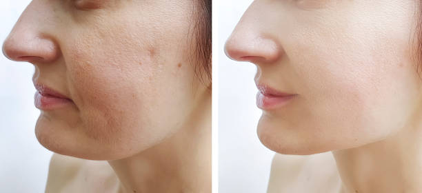 istock woman face wrinkles before and after treatment 1158875849