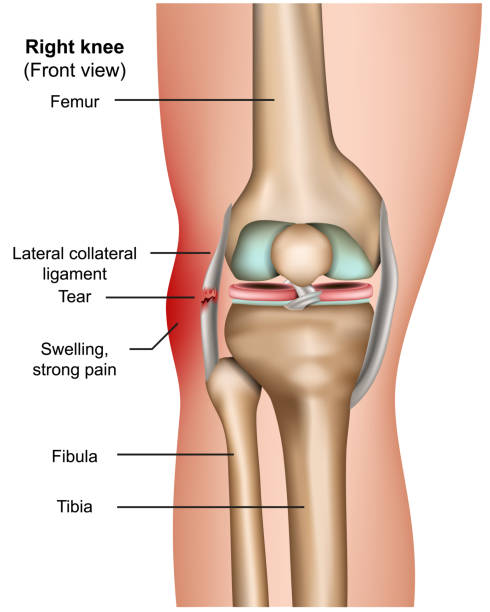 lateral collateral tear 3d medical vector infographic isoliert auf weißem hintergrund - cruciate ligament stock-grafiken, -clipart, -cartoons und -symbole