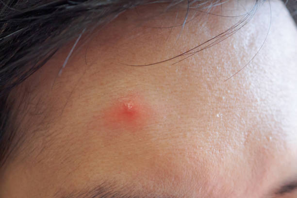 istock Inflammatory acne with red spot on face closeup 1159005337