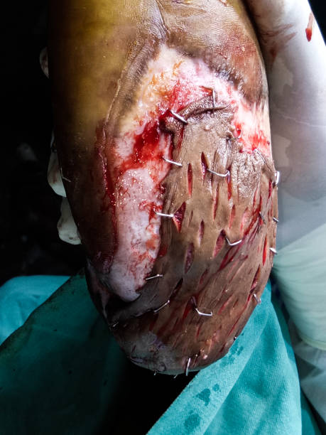 perforovaný kožní štěp v diabetické noze plastickou operací - gangréna - stock snímky, obrázky a fotky