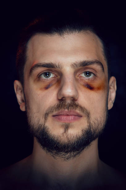 istock Young man with bruise black eye 1159195306
