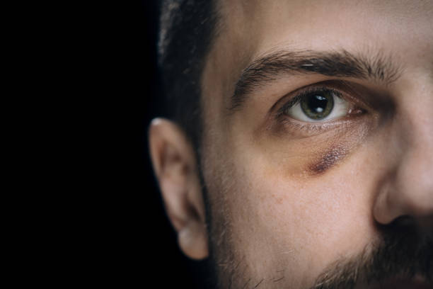 Man with bruise eye hematoma Man with bruise eye hematoma. Wounded victim with black eye. hematoma images stock pictures, royalty-free photos & images