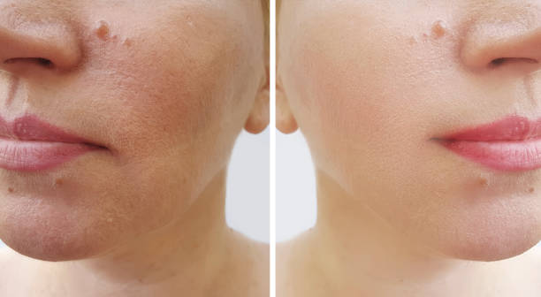 istock woman face wrinkles   after treatment 1159230918