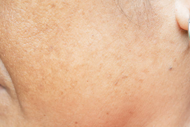 istock freckles on the face. in old women 1159313391