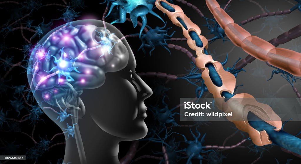 Multiple Sclerosis Nerve Disorder Multiple sclerosis nerve disorder and damaged myelin or MS autoimmune disease with healthy nerve with exposed fibre with scarrred cell sheath loss with 3D illustration elements. Multiple Sclerosis Stock Photo