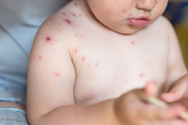 Little girl with varicella zoster virus Front view image of baby girl with chickenpox rash pox stock pictures, royalty-free photos & images