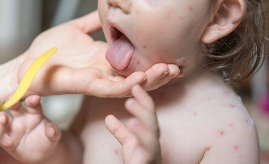 Close-up image of baby girl with varicella zoster infection showing out her tongue to the doctor