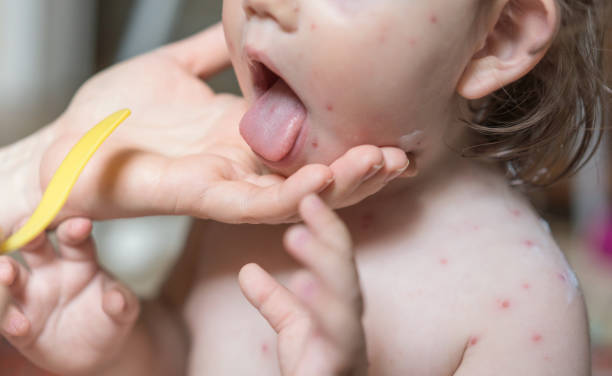 Little girl with chickenpox at the doctors stock photo
