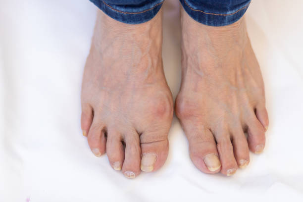 piedi con bunion (hallux valgus) - human foot bunion pain human toe foto e immagini stock
