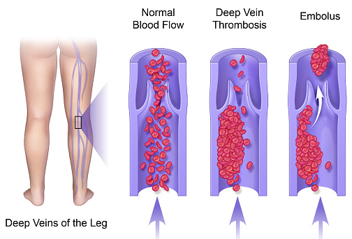 Deep vein thrombosis, or DVT, is a blood clot that forms in a vein deep in the body