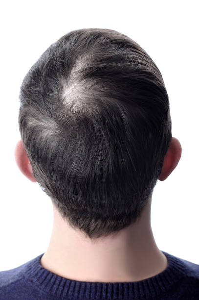 istock Men hair with a bald patch before using cosmetic powder to thicken hair. White isolate. 1159524608