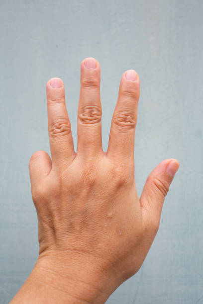 istock Trigger Finger lock on little finger of woman's front left hand, Suffering from pain, On Blue-grey colour background,  Close up & Macro shot, Office syndrome, Health care concept 1159543620
