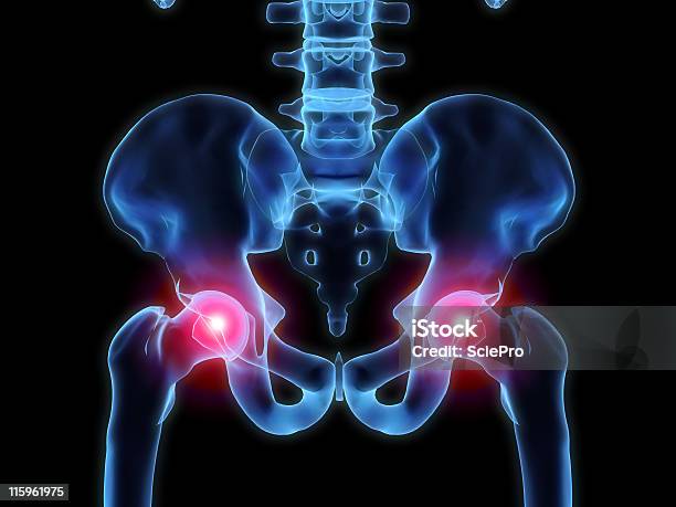 Xray Hip Pain Stock Photo - Download Image Now - Hip - Body Part, Pain, X-ray Image