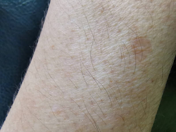 istock Spot on the skin 1159623096