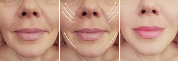 istock woman wrinkles face before and after correction arrow collage 1159637113