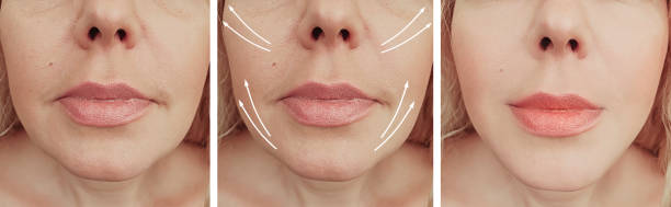 istock woman wrinkles face before and after correction arrow collage 1159638350