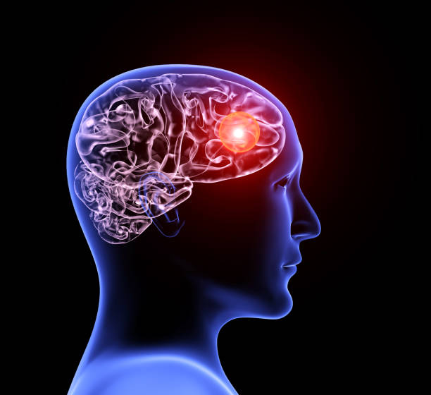 Human headache migraine Headache migraine. Human x-ray profile with brain, pain location highlighted in red. Isolated on black background. 3d render hematoma images stock pictures, royalty-free photos & images