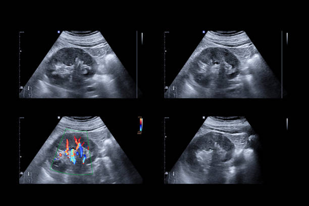 ultrasound upper abdomen or ultrasound kidney showing  anatomical of kidney and kidney function. - human upper body xray imagens e fotografias de stock
