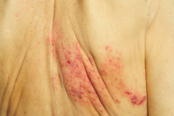 Shingles is a viral infection that causes a painful rash Shingles is a viral infection that causes a painful rash. shingles can occur anywhere on your body, it most often appears as a single stripe of blisters that wraps around either the left or the right side of your torso. shingles rash stock pictures, royalty-free photos & images