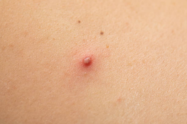 istock Red pimple on human skin 1159730420