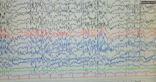 istock A computer monitor showing electrical activity of the brain, electroencephalogram,EEG 1159806922