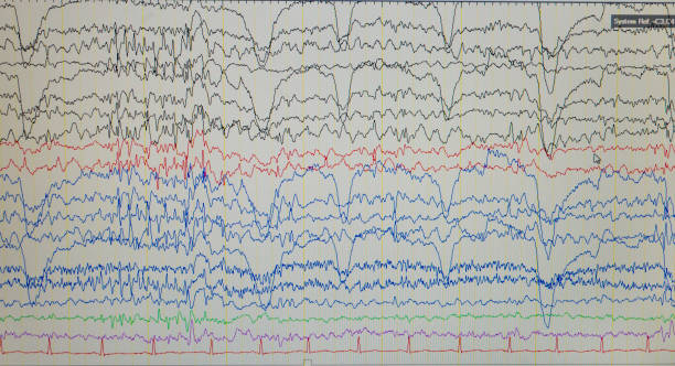 istock A computer monitor showing electrical activity of the brain, electroencephalogram,EEG 1159807163