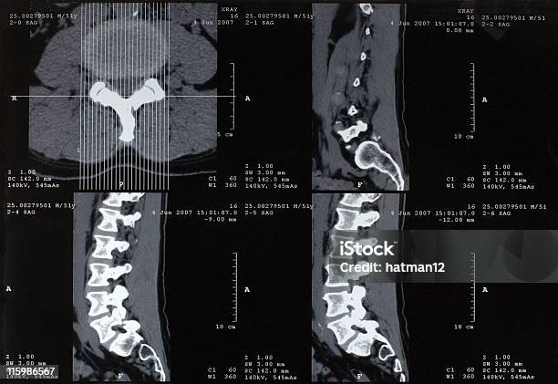 Radiografie Spinale - Fotografie stock e altre immagini di Ernia del disco - Ernia del disco, Rapporto, Anatomia umana