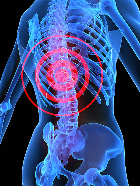 istock A graphic showing radiating pain from a backache 115990324