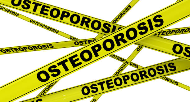 istock Osteoporosis. Yellow warning tapes 1160010586
