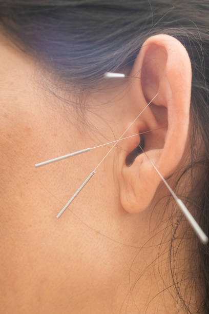 istock Woman's ear with needles. Acupuncture. Chinese Medicine 1160019671