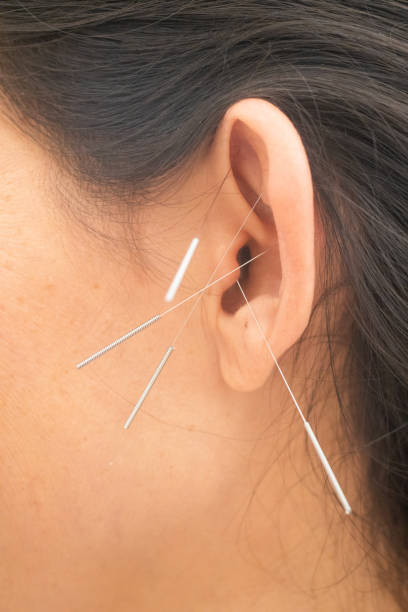 istock Woman's ear with needles. Acupuncture. Chinese Medicine 1160019827