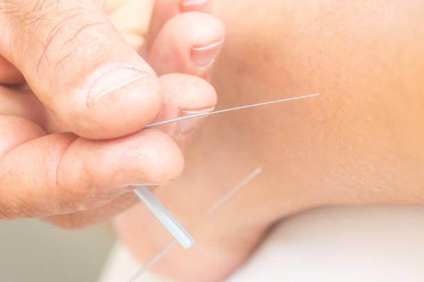 istock Acupuncture needles on the legs and foot 1160022240
