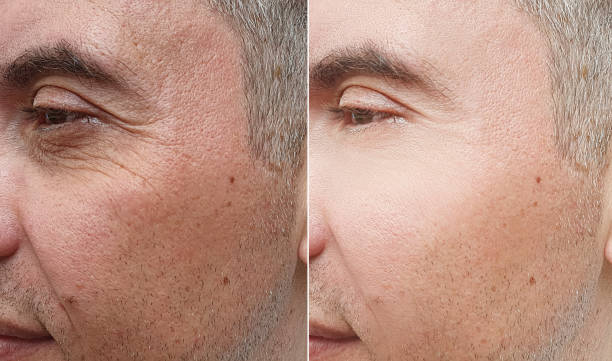man face wrinkles before and after treatment man face wrinkles before and after treatment botox before and after stock pictures, royalty-free photos & images