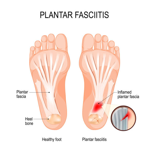 Plantar fasciitis. disorder of the connective tissue which supports the arch of the foot Plantar fasciitis. disorder of the connective tissue which supports the arch of the foot. vector diagram for medical, educational and scientific use fascitis stock illustrations